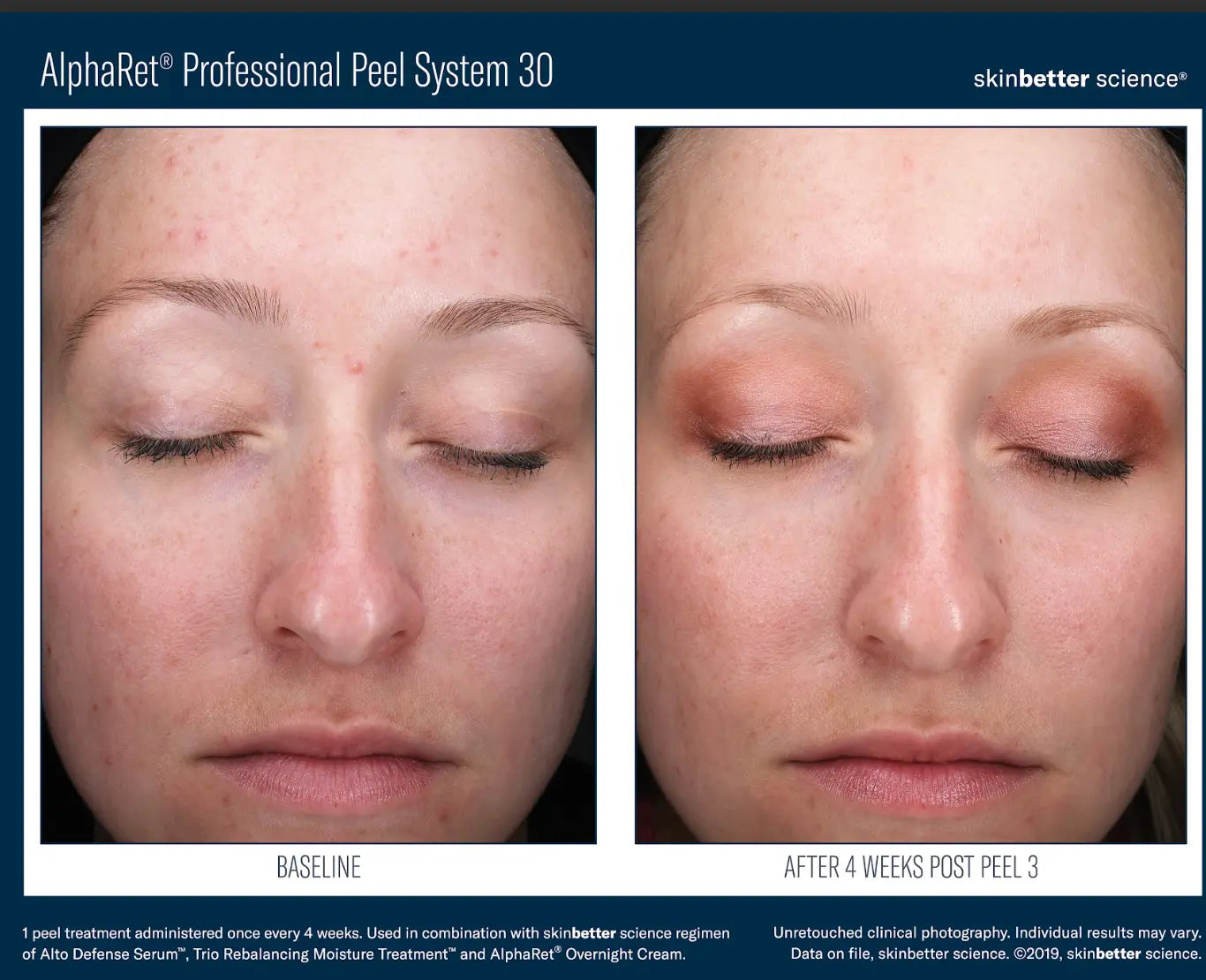 SKINBETTER ALPHARET CHEMICAL PEEL gilbert arizona