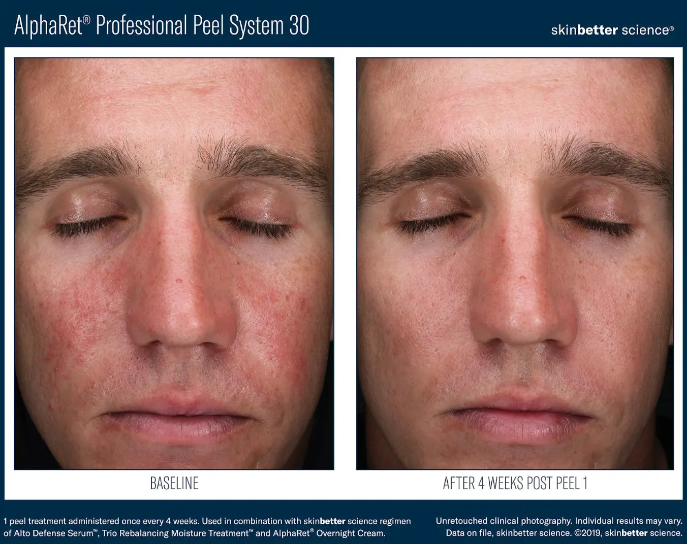 SKINBETTER CHEMICAL PEEL gilbert arizona