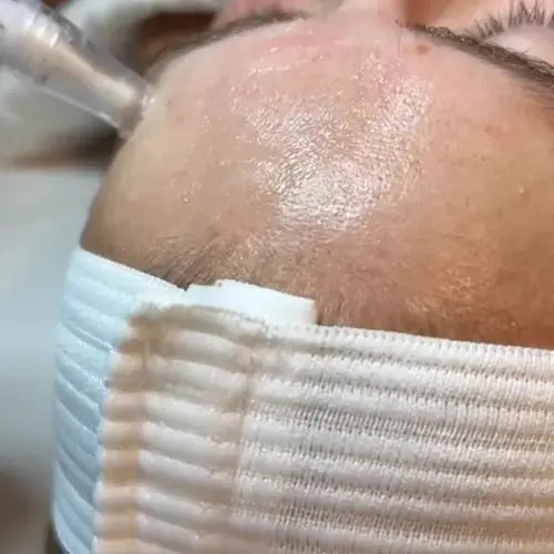 skinpen microneedling in gilbert, arizona