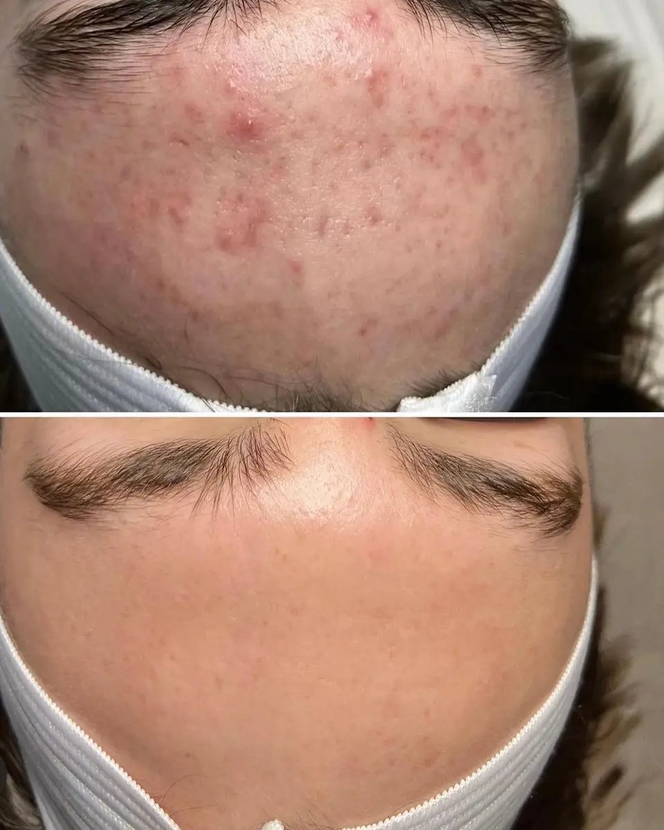 FACE REALITY ACNE TREATMENT Cleanse Modern Day Spa