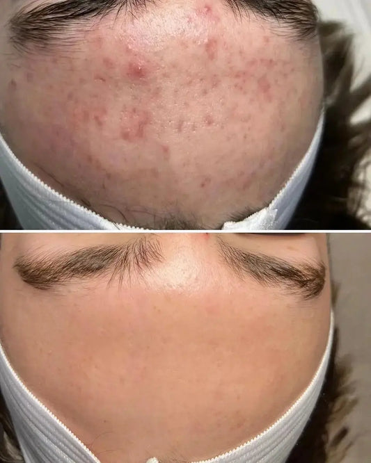 FACE REALITY ACNE TREATMENT Cleanse Modern Day Spa