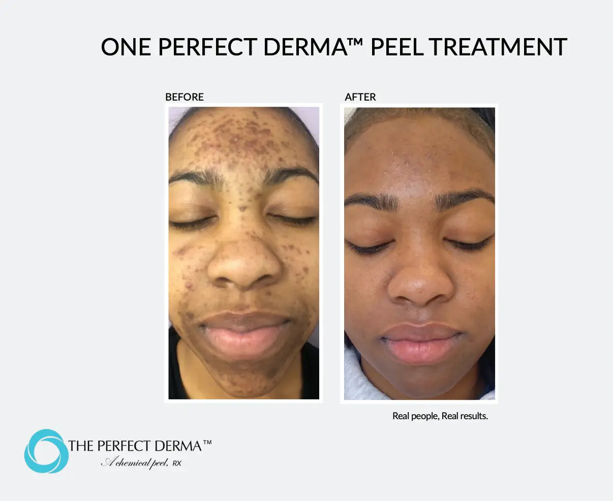 best Perfect Derma Chemical Peel Gilbert, Arizona | Cleanse Modern best Perfect Derma Chemical Peel Gilbert, Arizona | Cleanse Modern