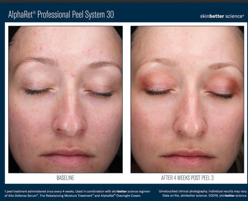 best Skinbetter AlphaRet Chemical Peel Gilbert, Arizona – Cleanse