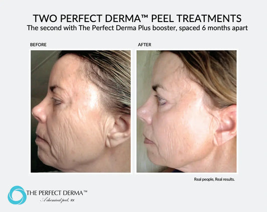 PERFECT DERMA™ PEEL Cleanse Modern Day Spa